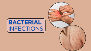 Bacterial Infections